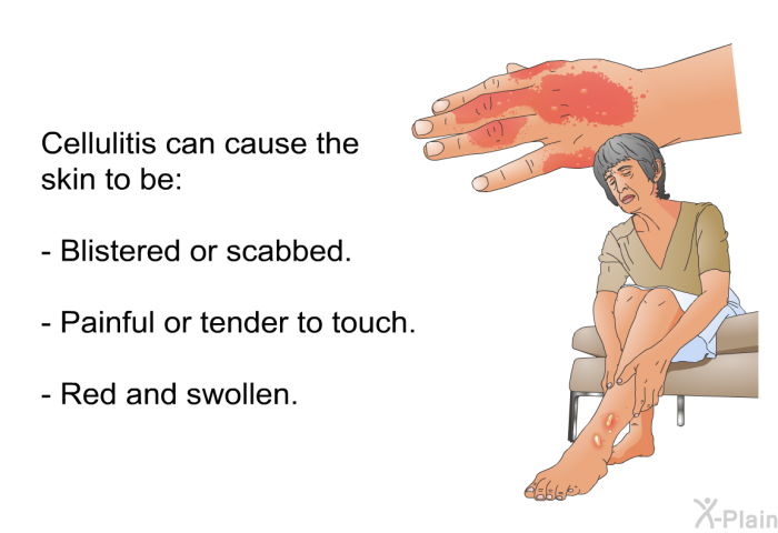 Cellulitis can cause the skin to be:  Blistered or scabbed. Painful or tender to touch. Red and swollen.