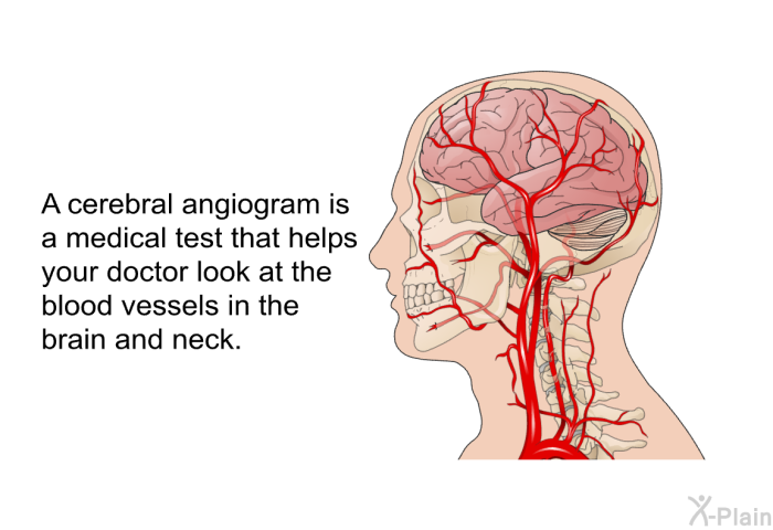 A cerebral angiogram is a medical test that helps your doctor look at the blood vessels in the brain and neck.