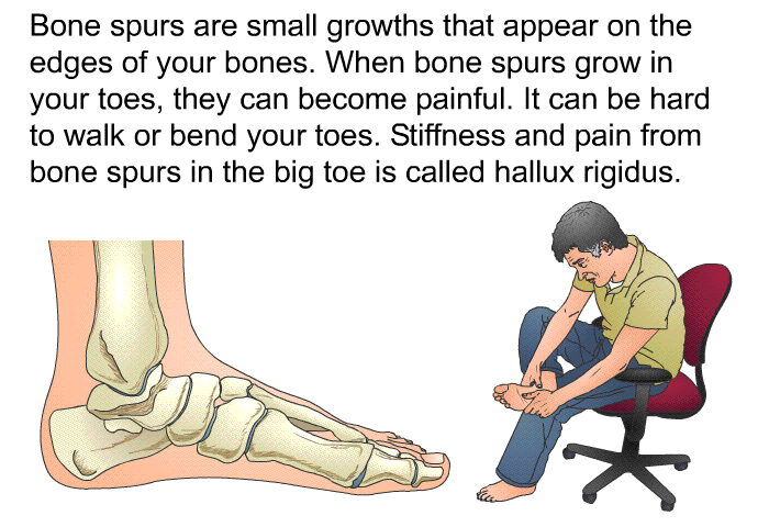 Bone spurs are small growths that appear on the edges of your bones. When bone spurs grow in your toes, they can become painful. It can be hard to walk or bend your toes. Stiffness and pain from bone spurs in the big toe is called hallux rigidus.