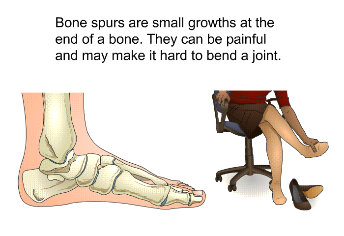 Bone spurs are small growths at the end of a bone. They can be painful and may make it hard to bend a joint.