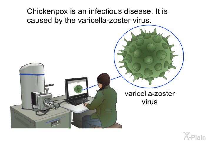Chickenpox is an infectious disease. It is caused by the varicella-zoster virus.