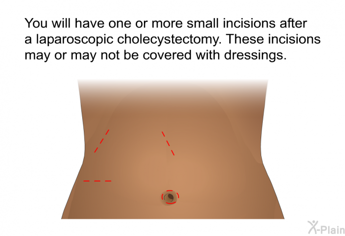 You will have one or more small incisions after a laparoscopic cholecystectomy. These incisions may or may not be covered with dressings.