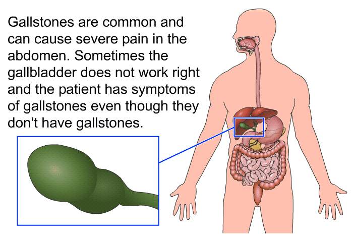Gallstones are common and can cause severe pain in the abdomen. Sometimes the gallbladder does not work right and the patient has symptoms of gallstones even though they don't have gallstones.