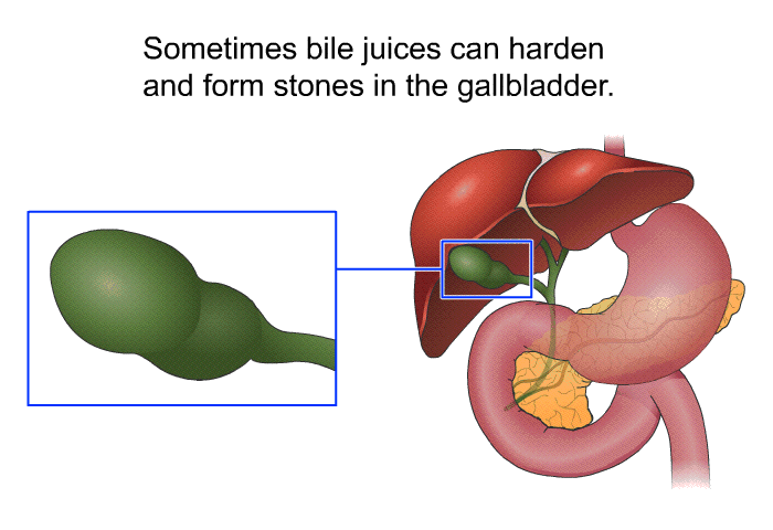 Sometimes bile juices can harden and form stones in the gallbladder.