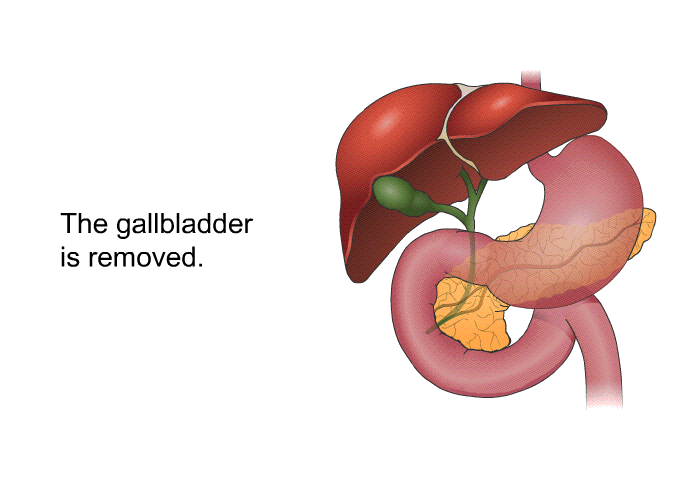 The gallbladder is removed.