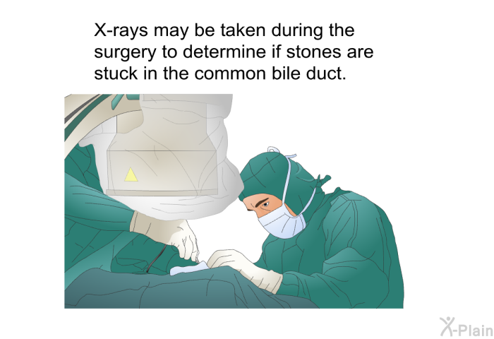 X-rays may be taken during the surgery to determine if stones are stuck in the common bile duct.