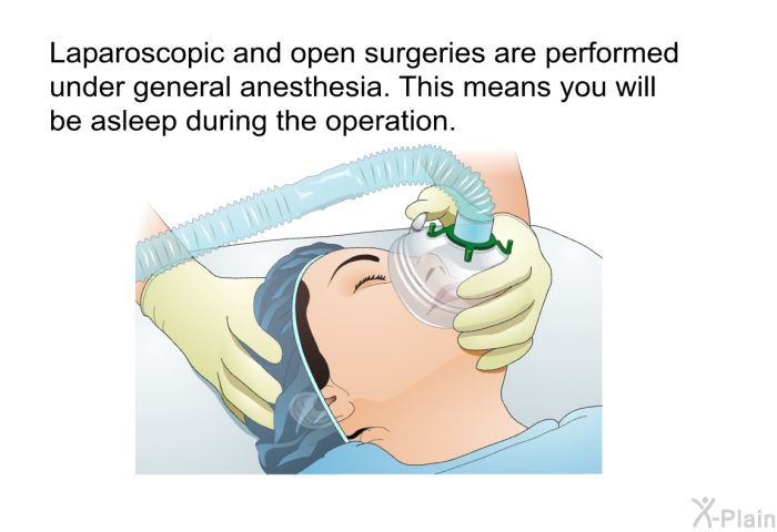 Laparoscopic and open surgeries are performed under general anesthesia. This means you will be asleep during the operation.