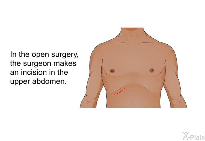 In the open surgery, the surgeon makes an incision in the upper abdomen.