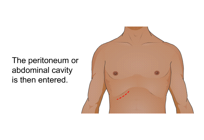 The peritoneum, or abdominal cavity, is then entered.