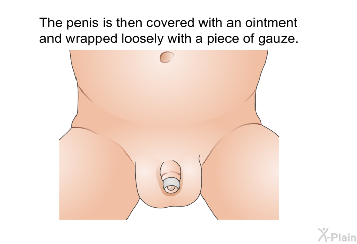 The penis is then covered with an ointment and wrapped loosely with a piece of gauze.