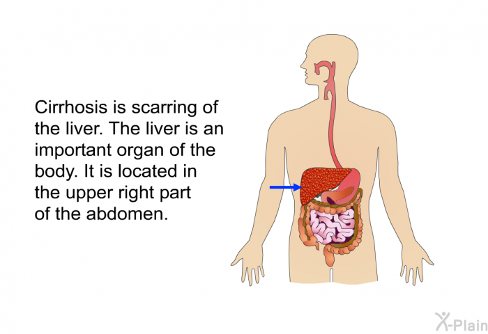 Cirrhosis is scarring of the liver. The liver is an important organ of the body. It is located in the upper right part of the abdomen.