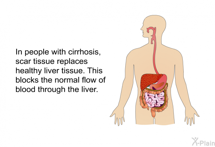 In people with cirrhosis, scar tissue replaces healthy liver tissue. This blocks the normal flow of blood through the liver.