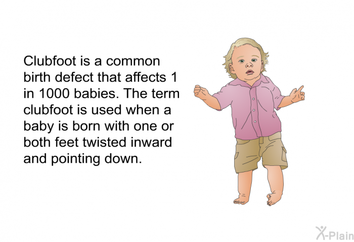 Clubfoot is a common birth defect that affects one in 1000 babies. The term clubfoot is used when a baby is born with 1 or both feet twisted inward and pointing down.