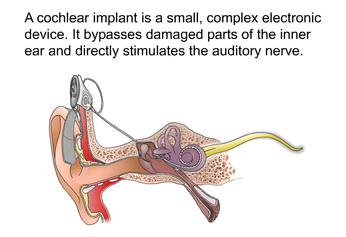 A cochlear implant is a small, complex electronic device. It bypasses damaged parts of the inner ear and directly stimulates the auditory nerve.