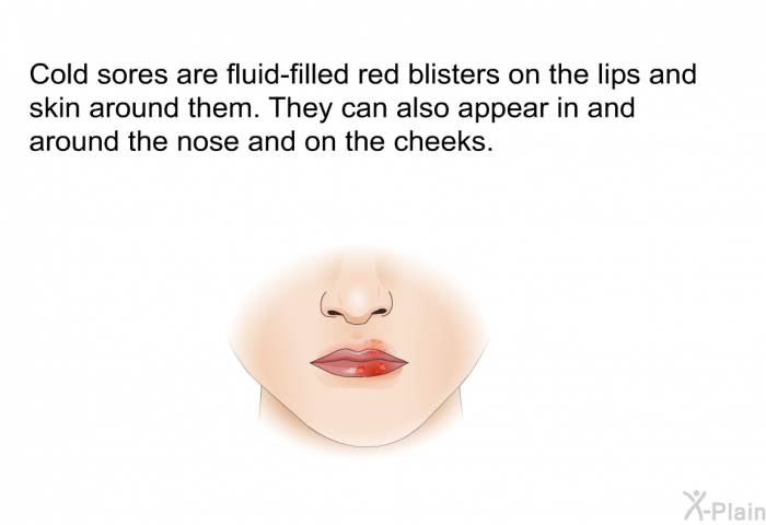 Cold sores are fluid-filled red blisters on the lips and skin around them. They can also appear in and around the nose and on the cheeks.