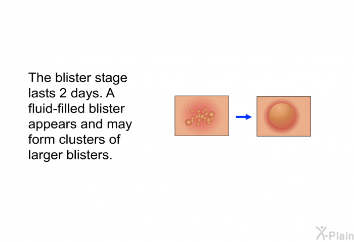 The blister stage lasts 2 days. A fluid-filled blister appears and may form clusters of larger blisters.