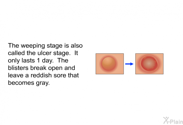 The weeping stage is also called the ulcer stage. It only lasts 1 day. The blisters break open and leave a reddish sore that becomes gray.