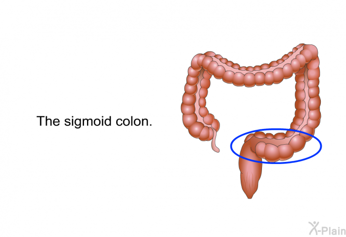 The sigmoid colon.