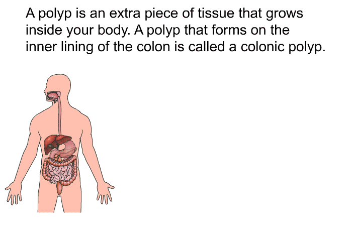 A polyp is an extra piece of tissue that grows inside your body. A polyp that forms on the inner lining of the colon is called a colonic polyp.