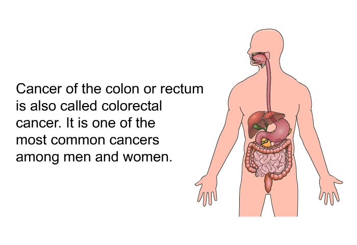 Cancer of the colon or rectum is also called colorectal cancer. It is one of the most common cancers among men and women.