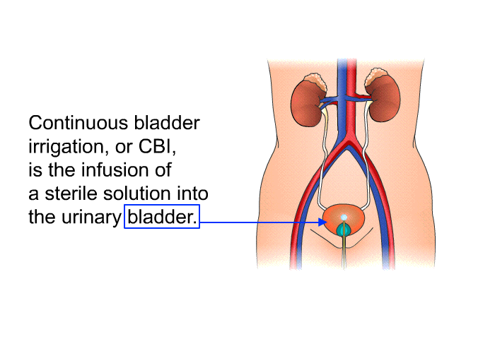 continuous bladder irrigation