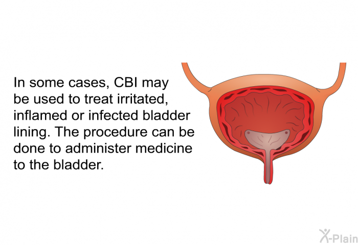In some cases, CBI may be used to treat irritated, inflamed or infected bladder lining. The procedure can be done to administer medicine to the bladder.