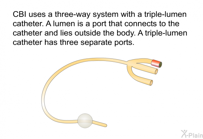 CBI uses a three-way system with a triple-lumen catheter. A lumen is a port that connects to the catheter and lies outside the body. A triple-lumen catheter has three separate ports.