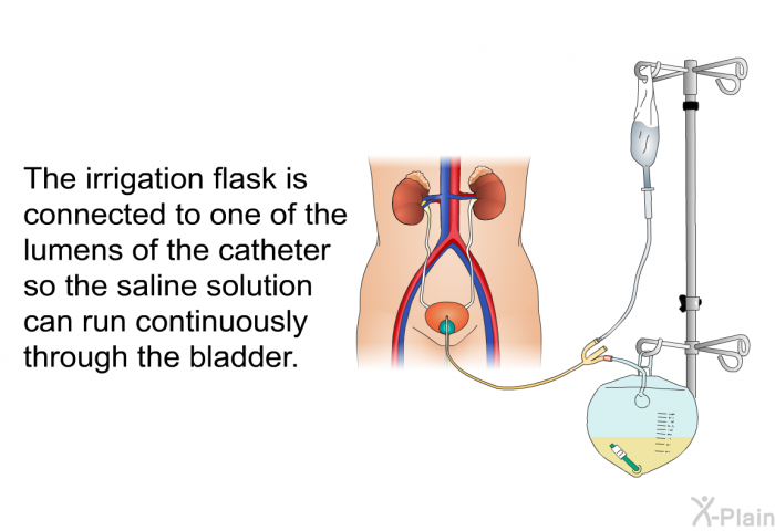 The irrigation flask is connected to one of the lumens of the catheter so the saline solution can run continuously through the bladder.