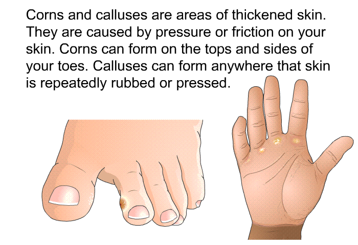 Corns and calluses are areas of thickened skin. They are caused by pressure or friction on your skin. Corns can form on the tops and sides of your toes. Calluses can form anywhere that skin is repeatedly rubbed or pressed.