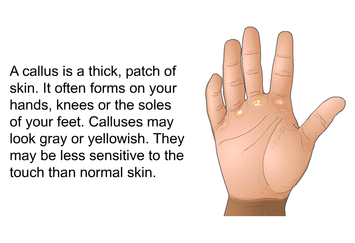 A callus is a thick, patch of skin. It often forms on your hands, knees or the soles of your feet. Calluses may look gray or yellowish. They may be less sensitive to the touch than normal skin.