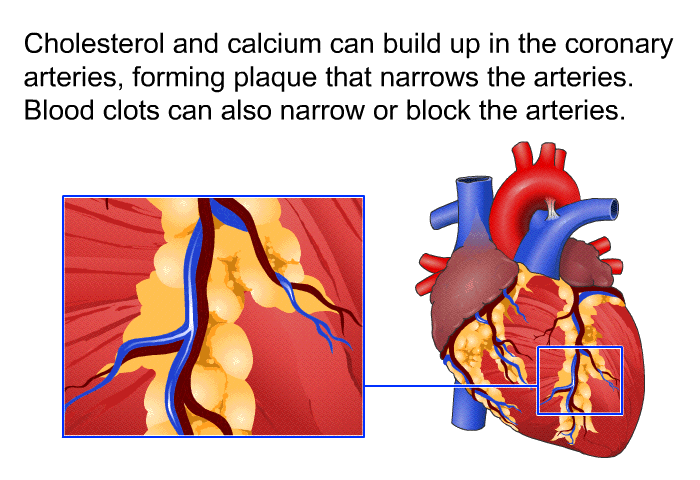Cholesterol and calcium can build up in the coronary arteries, forming plaque that narrows the arteries. Blood clots can also narrow or block the arteries.