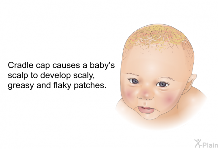 Cradle cap causes a baby's scalp to develop scaly, greasy and flaky patches.
