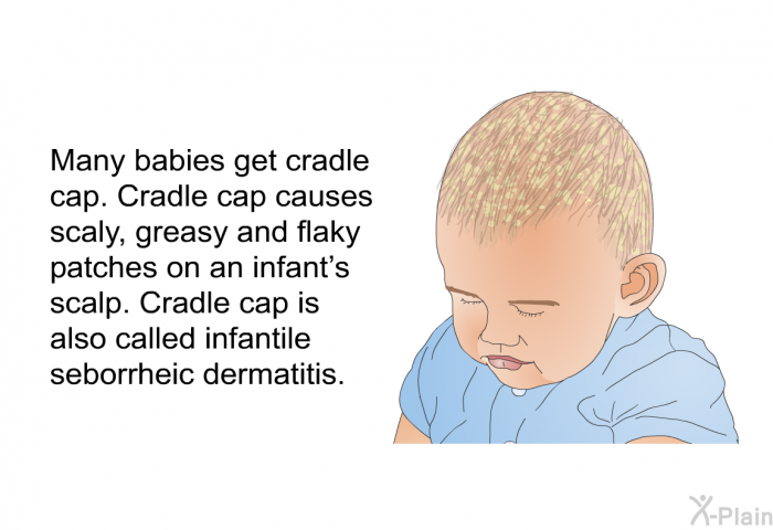 Many babies get cradle cap. Cradle cap causes scaly, greasy and flaky patches on an infant's scalp. Cradle cap is also called infantile seborrheic dermatitis.