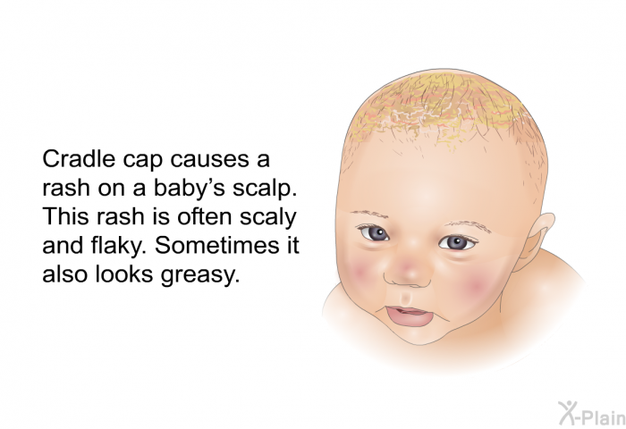 Cradle cap causes a rash on a baby's scalp. This rash is often scaly and flaky. Sometimes it also looks greasy.