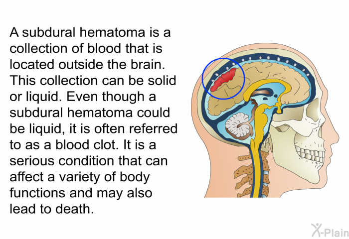 A subdural hematoma is a collection of blood that is located outside the brain. This collection can be solid or liquid. Even though a subdural hematoma could be liquid, it is often referred to as a blood clot. It is a serious condition that can affect a variety of body functions and may also lead to death.