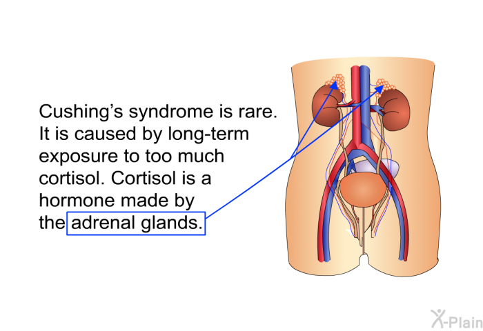 Cushing's syndrome is rare. It is caused by long-term exposure to too much cortisol. Cortisol is a hormone made by the adrenal glands.
