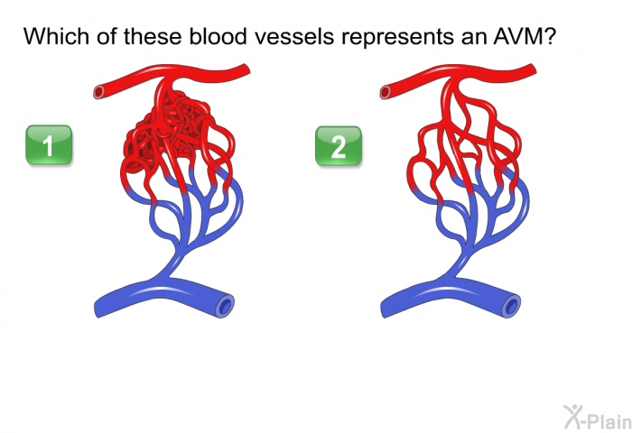 Which of these blood vessels represents an AVM? Press A or B (A points to a web of vessels between larger arteries and veins ; B points to a web of tiny vessels betw1een red-colored arteries and blue-colored veins.)