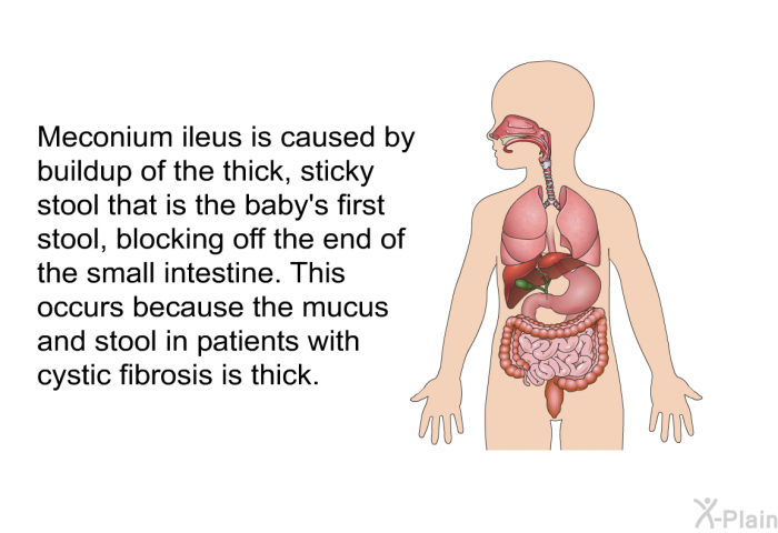 meconium ileus