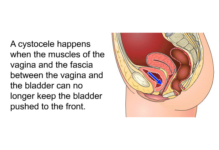A cystocele happens when the muscles of the vagina and the fascia between the vagina and the bladder can no longer keep the bladder pushed to the front.