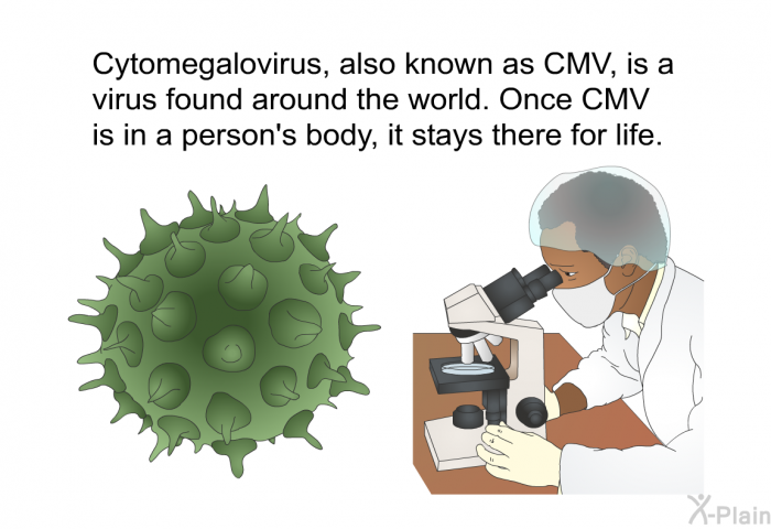 Cytomegalovirus, also known as CMV, is a virus found around the world. Once CMV is in a person's body, it stays there for life.