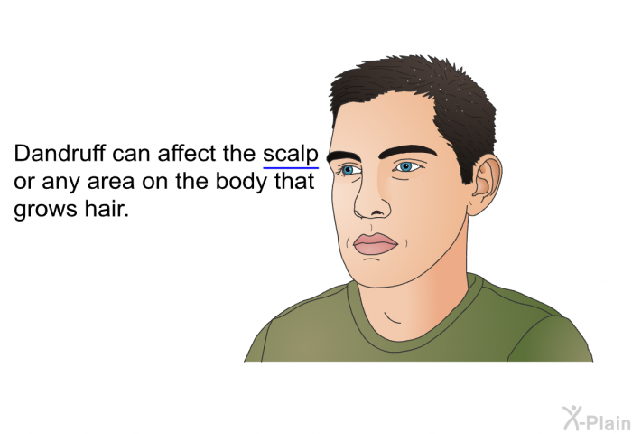 Dandruff can affect the scalp or any area on the body that grows hair.
