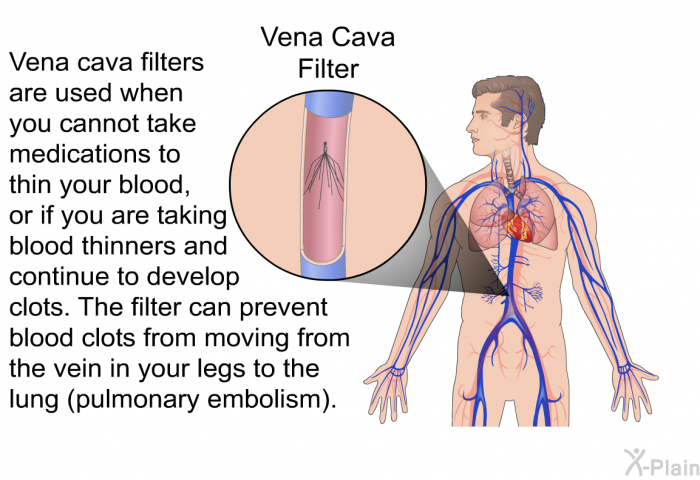 Vena cava filters are used when you cannot take medications to thin your blood, or if you are taking blood thinners and continue to develop clots. The filter can prevent blood clots from moving from the vein in your legs to the lung (pulmonary embolism).