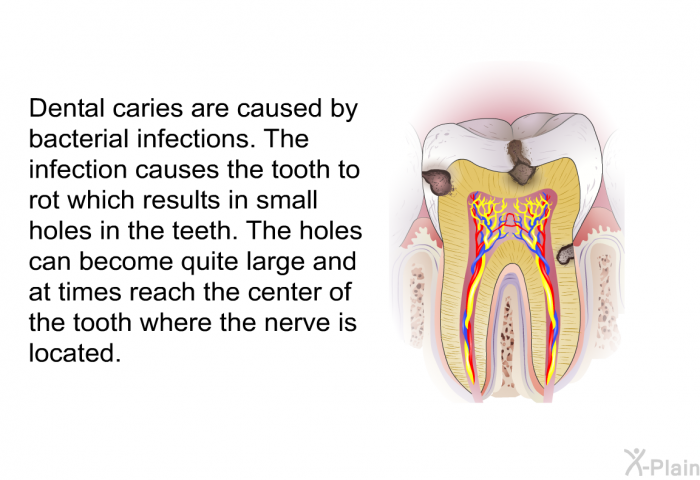 Dental caries are caused by bacterial infections. The infection causes the tooth to rot which results in small holes in the teeth. The holes can become quite large and at times reach the center of the tooth where the nerve is located.