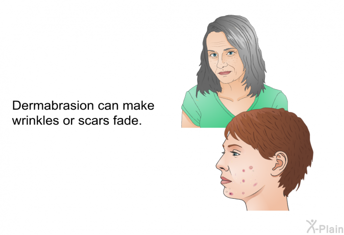 Dermabrasion can make wrinkles or scars fade.