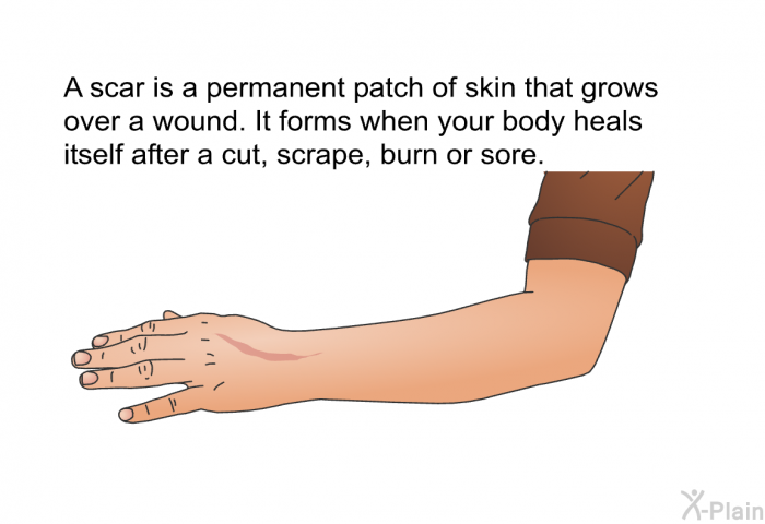 A scar is a permanent patch of skin that grows over a wound. It forms when your body heals itself after a cut, scrape, burn or sore.