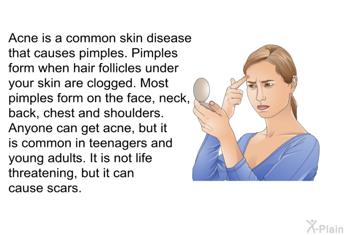 Acne is a common skin disease that causes pimples. Pimples form when hair follicles under your skin are clogged. Most pimples form on the face, neck, back, chest and shoulders. Anyone can get acne, but it is common in teenagers and young adults. It is not life threatening, but it can cause scars.