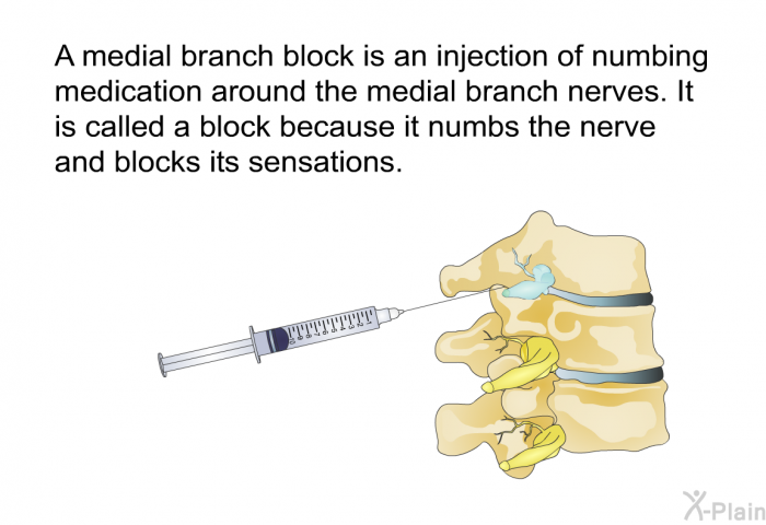 A medial branch block is an injection of numbing medication around the medial branch nerves. It is called a block because it numbs the nerve and blocks its sensations.