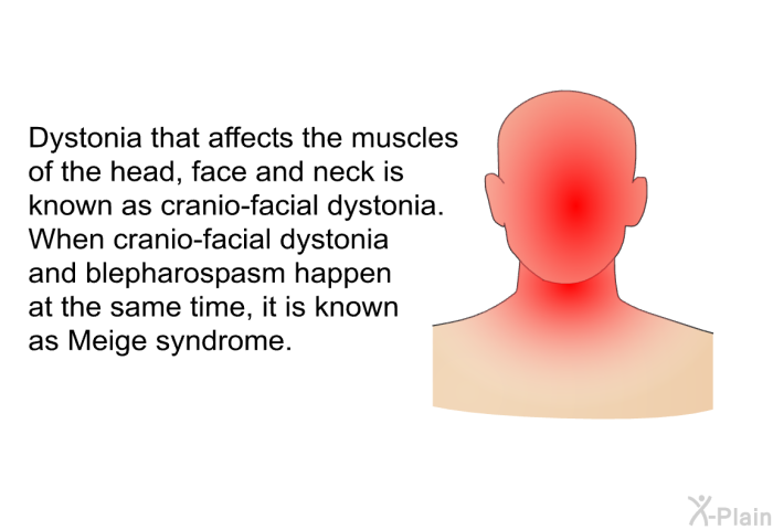 Dystonia that affects the muscles of the head, face and neck is known as cranio-facial dystonia. When cranio-facial dystonia and blepharospasm happen at the same time, it is known as Meige syndrome.