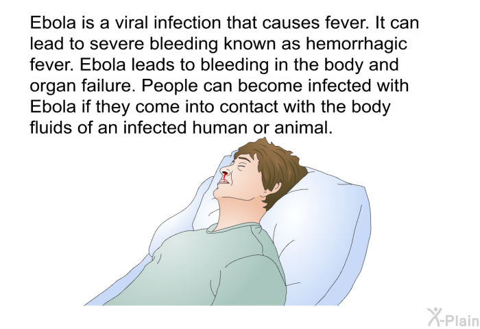 Ebola is a viral infection that causes fever. It can lead to severe bleeding known as hemorrhagic fever. Ebola leads to bleeding in the body and organ failure. People can become infected with Ebola if they come into contact with the body fluids of an infected human or animal.