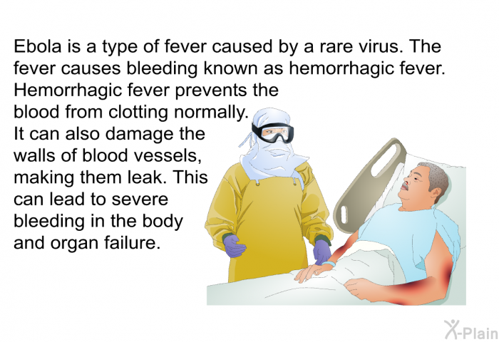 Ebola is a type of fever caused by a rare virus. The fever causes bleeding known as hemorrhagic fever. Hemorrhagic fever prevents the blood from clotting normally. It can also damage the walls of blood vessels, making them leak. This can lead to severe bleeding in the body and organ failure.